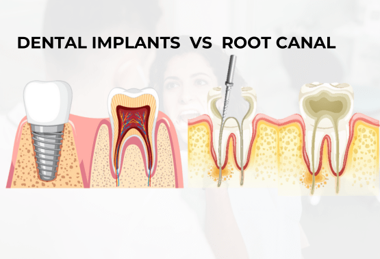 Dental Implants In Hosur