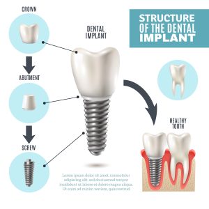 Dental Implant Surgery in Hosur