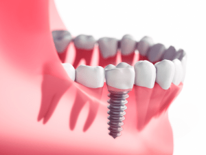 Exploring the Benefits of Dental Implants for Missing Teeth