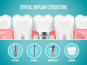 How to Implant Teeth