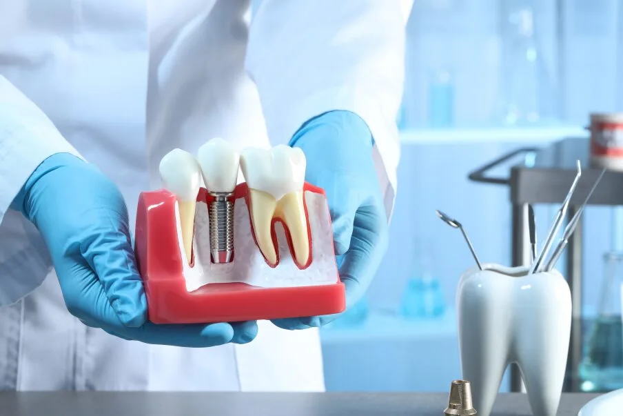 How to Implant Teeth for a Radiant Smile