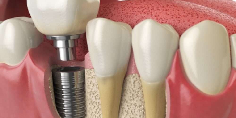 implant dentistry