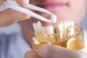 Best Tooth Replacement Solution